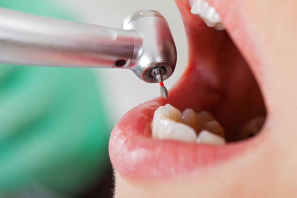 Best Emergency Broken Tooth Repair in Bessemer, MI